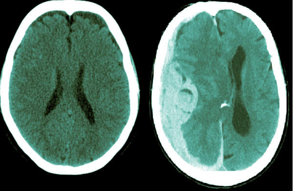 Brain Bleed Sideby Side comparison with normal. Midline shift