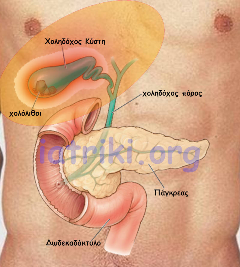 Οξεία Χολοκυστίτιδα