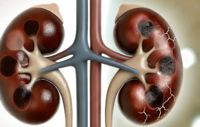 A medical illustration failing kidneys. The image depicts a pair of kidneys with visible damage or signs of dysfunction,