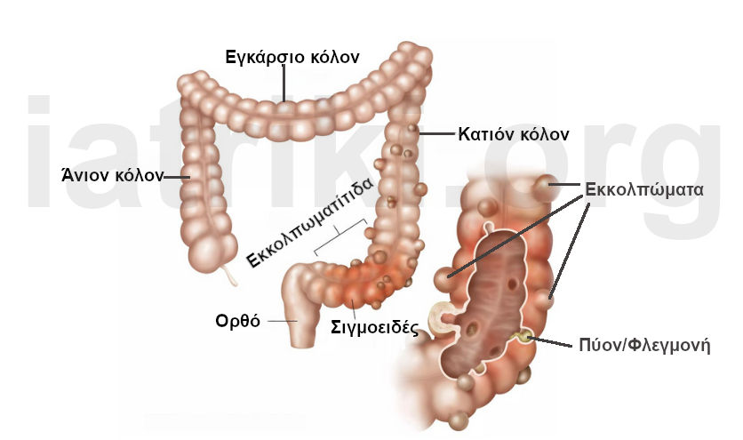 Απεικόνιση του παχέος εντέρου με οξεία εκκολπωματίτιδα. Φλεγμονώδη εκκολπώματα με παρουσία πύου στο σιγμοειδές τμήμα. Διακρίνονται το άνιον κόλον, το εγκάρσιον κόλον, το κατιόν κόλον, το σιγμοειδές και το ορθό έντερο.