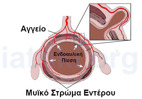 Εικόνα που απεικονίζει τον μηχανισμό δημιουργίας εκκολπώματος λόγω αυξημένης ενδοαυλικής πίεσης μέσα στο έντερο, με προβολή του βλεννογόνου μέσα από αδύναμο σημείο του τοιχώματος